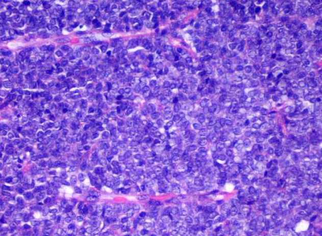 Fig.2.-Tumor indiferenciado de clula pequea redonda (H-E x 100).